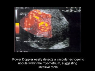 Power Doppler easily detects a vascular echogenic
nodule within the myometrium, suggesting
invasive mole
 