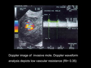 Doppler image of invasive mole. Doppler waveform
analysis depicts low vascular resistance (RI= 0.35)
 