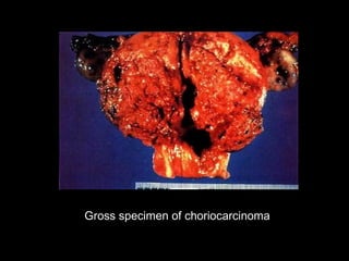 Gross specimen of choriocarcinoma
 