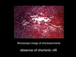 Microscopic image of choriocarcinoma
absence of chorionic villiabsence of chorionic villi
 