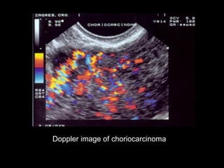 Doppler image of choriocarcinoma
 