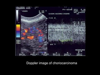 Doppler image of choriocarcinoma
 