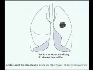 IIIa<3cm or locate in half lung
IIIb disease beyond IIIa
 