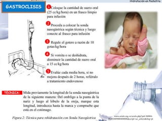 Hidratación en Pediatría
GASTROCLISIS ❶
❷
❸
❹
❺
TÉCNICA:
http://www.scielo.org.ve/scielo.php?pid=S0004-
06492009000400008&script=sci_arttext&tlng=pt
 