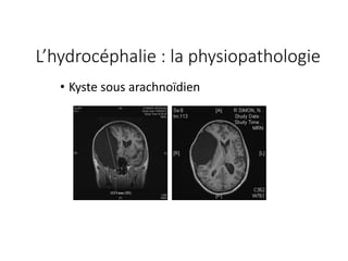 • Kyste	sous	arachnoïdien
L’hydrocéphalie	:	la	physiopathologie
 