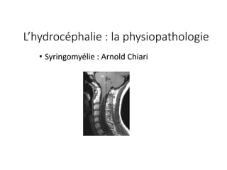 • Syringomyélie	:	Arnold	Chiari
L’hydrocéphalie :	la	physiopathologie
 