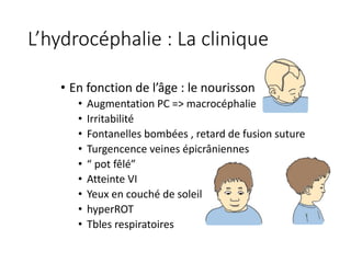 L’hydrocéphalie	:	La	clinique	
• En fonction de	l’âge :	le	nourisson
• Augmentation	PC	=>	macrocéphalie
• Irritabilité
• Fontanelles	bombées ,	retard	de	fusion	suture
• Turgencence veines épicrâniennes
• “	pot	fêlé”
• Atteinte VI
• Yeux en couché de	soleil
• hyperROT
• Tbles respiratoires
 