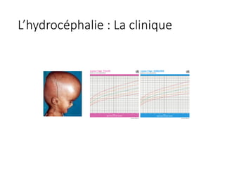 L’hydrocéphalie	:	La	clinique	
 