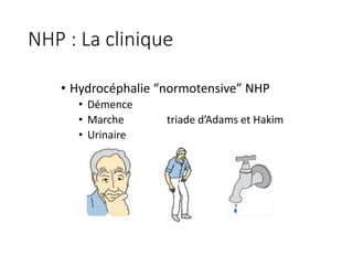 NHP	:	La	clinique	
• Hydrocéphalie	“normotensive”	NHP
• Démence
• Marche triade	d’Adams	et	Hakim
• Urinaire
 