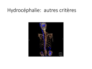 Hydrocéphalie:		autres	critères
 