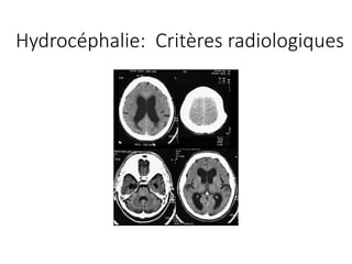 Hydrocéphalie:		Critères radiologiques
 