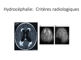 Hydrocéphalie:		Critères radiologiques
 