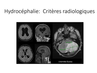 Lhermitte Duclos
Hydrocéphalie:		Critères radiologiques
 