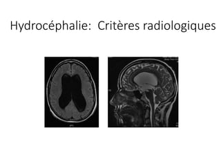 Hydrocéphalie:		Critères radiologiques
 