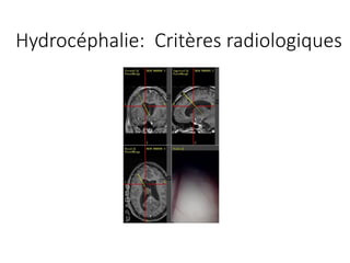 Hydrocéphalie:		Critères radiologiques
 