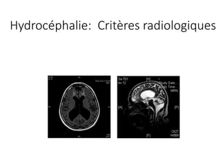 Hydrocéphalie:		Critères radiologiques
 