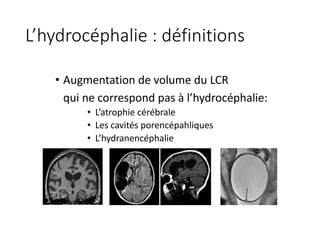 L’hydrocéphalie	:	définitions
• Augmentation	de	volume	du	LCR	
qui	ne	correspond	pas	à	l’hydrocéphalie:
• L’atrophie	cérébrale
• Les	cavités	porencépahliques
• L’hydranencéphalie
 