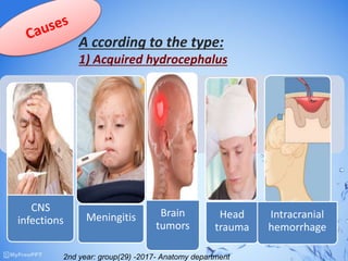 A ccording to the type:
1) Acquired hydrocephalus
.
CNS
infections Meningitis Brain
tumors
Head
trauma
Intracranial
hemorrhage
2nd year: group(29) -2017- Anatomy department
 