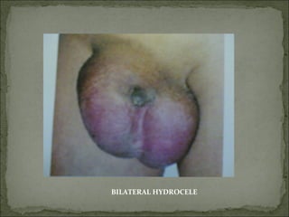 BILATERAL HYDROCELE