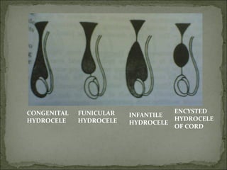 CONGENITAL FUNICULAR ENCYSTED
INFANTILE
HYDROCELE HYDROCELE HYDROCELE
HYDROCELE
OF CORD