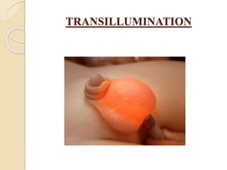 TRANSILLUMINATION
 