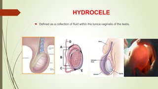 HYDROCELE
 Defined as a collection of fluid within the tunica vaginalis of the testis.
 