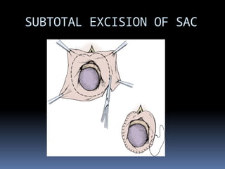 Subtotal Sacrectomy HYDROCELE , complications and its management | PPTX