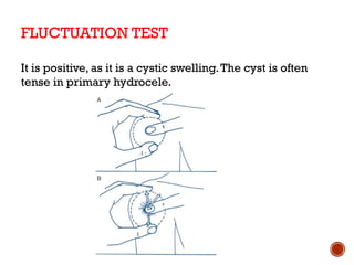 hydrocele types complete version-1.pptx