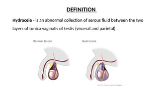 Hydrocleses Hydrocele types and examination and management | PPTX