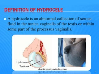 DEFINITION OF HYDROCELE
 A hydrocele is an abnormal collection of serous
fluid in the tunica vaginalis of the testis or within
some part of the processus vaginalis.
12
 