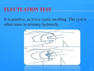 FLUCTUATION TEST
It is positive, as it is a cystic swelling. The cyst is
often tense in primary hydrocele.
19
 