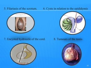 5. Filariasis of the scrotum. 6. Cysts in relation to the epididymis
7. Encysted hydrocele of the cord. 8. Tumours of the testis
23
 