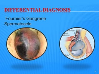 DIFFERENTIAL DIAGNOSIS
Fournier’s Gangrene
Spermatocele
24
24
 