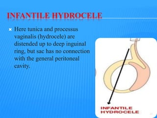 INFANTILE HYDROCELE
 Here tunica and processus
vaginalis (hydrocele) are
distended up to deep inguinal
ring, but sac has no connection
with the general peritoneal
cavity.
28
 