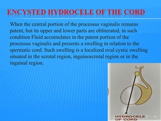 ENCYSTED HYDROCELE OF THE CORD
When the central portion of the processus vaginalis remains
patent, but its upper and lower parts are obliterated, in such
condition Fluid accumulates in the patent portion of the
processus vaginalis and presents a swelling in relation to the
spermatic cord. Such swelling is a localized oval cystic swelling
situated in the scrotal region, inguinoscrotal region or in the
inguinal region.
29
 