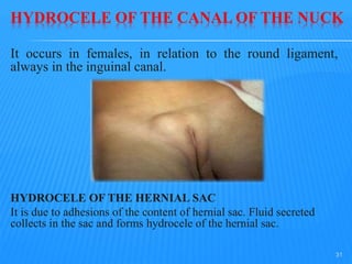 HYDROCELE OF THE CANAL OF THE NUCK
It occurs in females, in relation to the round ligament,
always in the inguinal canal.
HYDROCELE OF THE HERNIAL SAC
It is due to adhesions of the content of hernial sac. Fluid secreted
collects in the sac and forms hydrocele of the hernial sac.
31
 