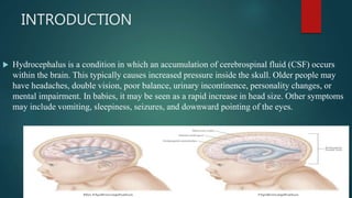 INTRODUCTION
 Hydrocephalus is a condition in which an accumulation of cerebrospinal fluid (CSF) occurs
within the brain. This typically causes increased pressure inside the skull. Older people may
have headaches, double vision, poor balance, urinary incontinence, personality changes, or
mental impairment. In babies, it may be seen as a rapid increase in head size. Other symptoms
may include vomiting, sleepiness, seizures, and downward pointing of the eyes.
 
