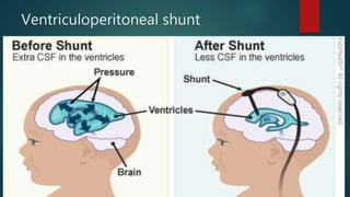 Ventriculoperitoneal shunt
 