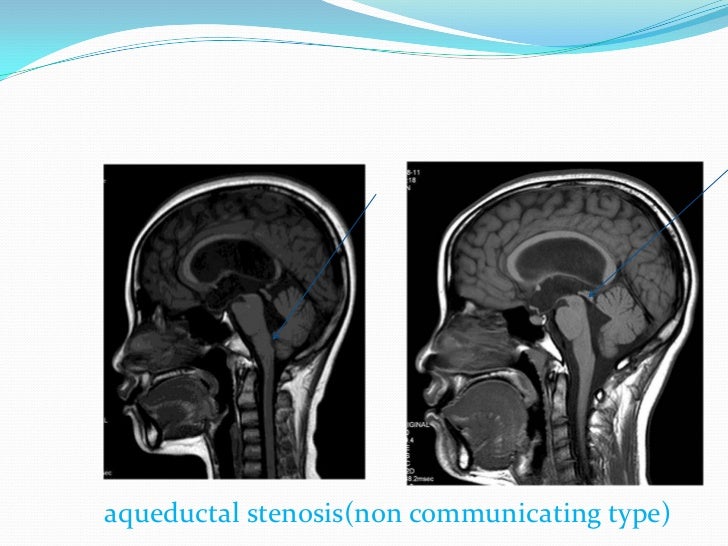 Hydrocephalus