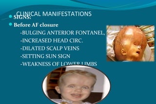 CLINICAL MANIFESTATIONS
SIGNS:
Before AF closure
    -BULGING ANTERIOR FONTANEL,
    -INCREASED HEAD CIRC.
    -DILATED SCALP VEINS
    -SETTING SUN SIGN
    -WEAKNESS OF LOWER LIMBS
 