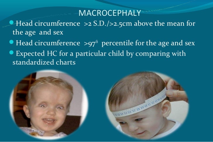 Macrocephaly Head Circumference Chart
