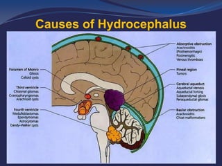 Causes of Hydrocephalus

12

 
