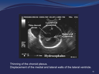Thinning of the choroid plexus.
Displacement of the medial and lateral walls of the lateral ventricle.
15

 