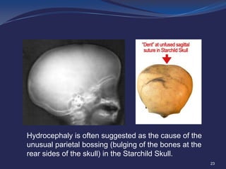 Hydrocephaly is often suggested as the cause of the
unusual parietal bossing (bulging of the bones at the
rear sides of the skull) in the Starchild Skull.
23

 