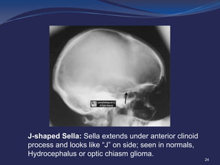 J-shaped Sella: Sella extends under anterior clinoid
process and looks like “J” on side; seen in normals,
Hydrocephalus or optic chiasm glioma.
24

 