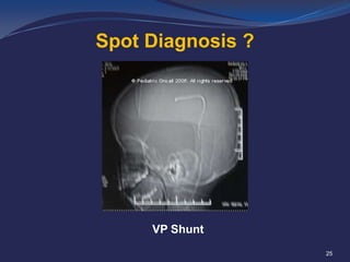 Spot Diagnosis ?

VP Shunt
25

 