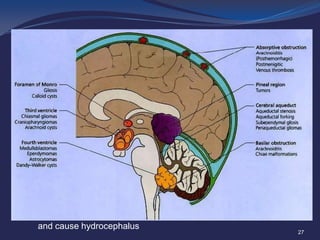 ?

Colloid Cysts are usually located in the anterior (front) portion
of the third ventricle, resting against the hypothalamus, where
they may block the outflow pathways for the cerebrospinal fluid
and cause hydrocephalus

27

 
