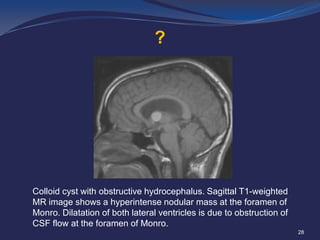 ?

Colloid cyst with obstructive hydrocephalus. Sagittal T1-weighted
MR image shows a hyperintense nodular mass at the foramen of
Monro. Dilatation of both lateral ventricles is due to obstruction of
CSF flow at the foramen of Monro.
28

 