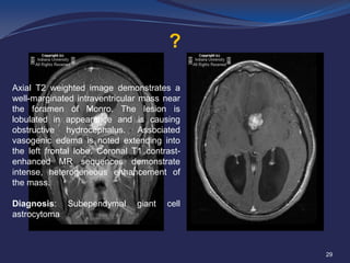 ?
Axial T2 weighted image demonstrates a
well-marginated intraventricular mass near
the foramen of Monro. The lesion is
lobulated in appearance and is causing
obstructive hydrocephalus. Associated
vasogenic edema is noted extending into
the left frontal lobe. Coronal T1 contrastenhanced MR sequences demonstrate
intense, heterogeneous enhancement of
the mass.
Diagnosis: Subependymal
astrocytoma

giant

cell

29

 