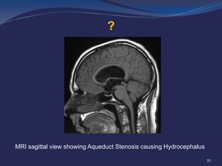 ?

MRI sagittal view showing Aqueduct Stenosis causing Hydrocephalus
31

 